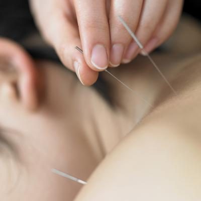 Femmes reçoit un traitement d'acupuncture
