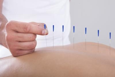 L'acupuncture est un traitement alternatif.