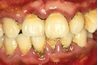 Taches de nicotine sur les dents sont inesthétiques et mauvais pour la santé bucco-dentaire.