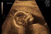 Ultrason image de bébé