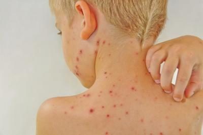 Si vous aviez la varicelle comme un enfant, vous pouvez développer le zona à l'âge adulte.