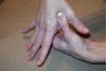 Retirer noeuds musculaires dans la main