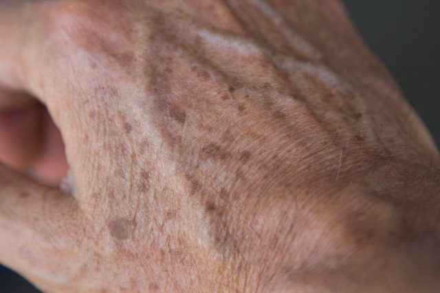 Comment enlever la peau taches de vieillesse Naturellement