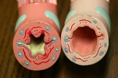 Les modèles montrent différence entre une voie respiratoire sain et enflammé par l'asthme
