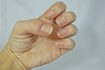 Comment guérir et prévenir Cracked peau autour ongles